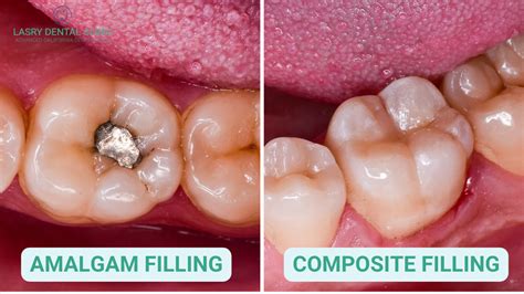 What Do They Use To Fill Cavities at Jett Arkwookerum blog