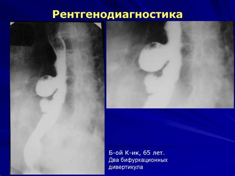 Дивертикулы пищевода - презентация онлайн