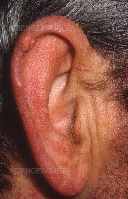 Gout Tophi on Ear Cartilage | Stock Image - Science Source Images