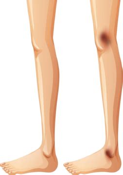 Human Legs And Bruise On White Background Ache People Background Vector ...