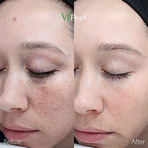 Chemical Peels | Derm Aesthetics of Northern Kentucky