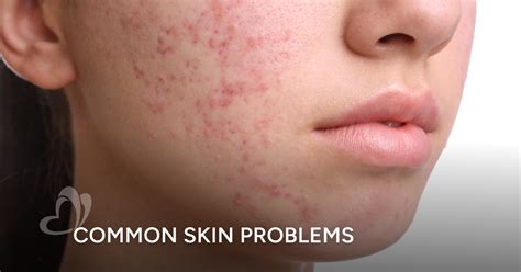 common skin disorders  singapore thomson medical