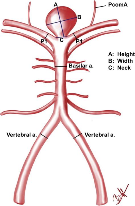 Asymmetry of P1 and vertebral arteries is not related to basilar tip ...