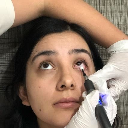 Blephex for Blepharitis | Dr. Chinn's Vision Care