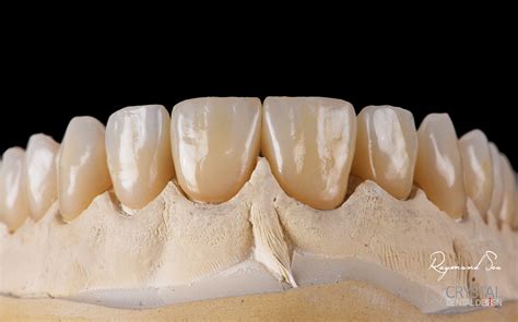All Ceramic Aesthetics - Crystal Dental Design