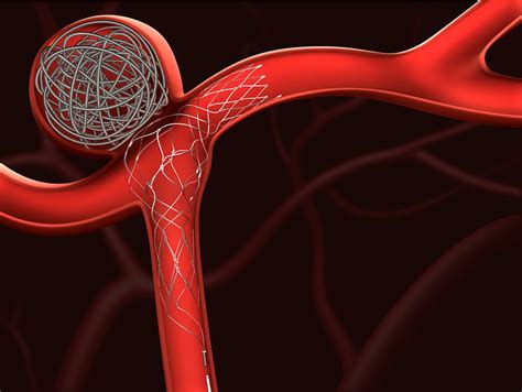 coil  aneurysm  anthony barajas blog