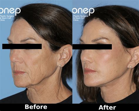 face  neck lift onep
