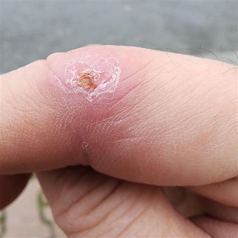 Skin sore on index finger joint : r/DermatologyQuestions