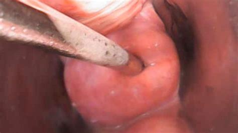 triplextransmanxxx extreme cervix  uterine penetration ends