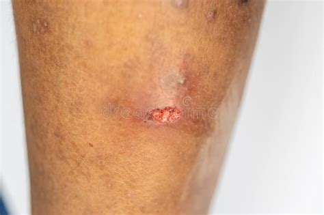 Atopic Dermatitis and Fungal Diseases on the Human Body. Stock Image ...