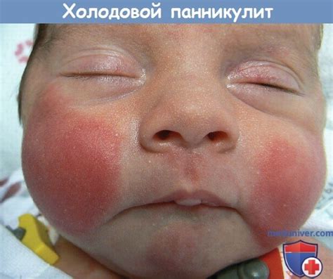 Холодовой панникулит - причины, диагностика, лечение