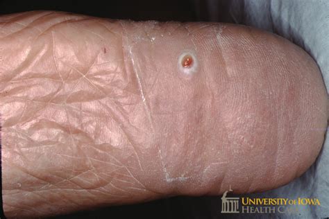 Red papule with macerated collarette of scale on the plantar foot ...