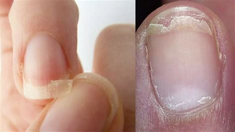 Nail disorders - Chuah Sai Yee Dermatology Clinic