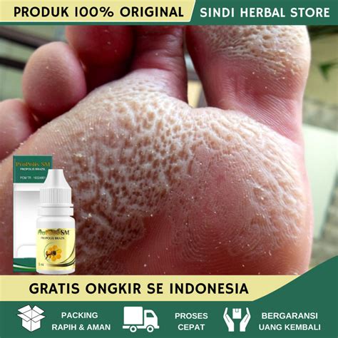jual obat kaki rayapan  bau obat kaki bolong bolong obat oles kaki