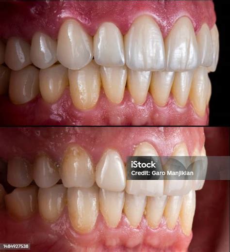 mahkota  veneer keramik emax  gigi alami foto stok