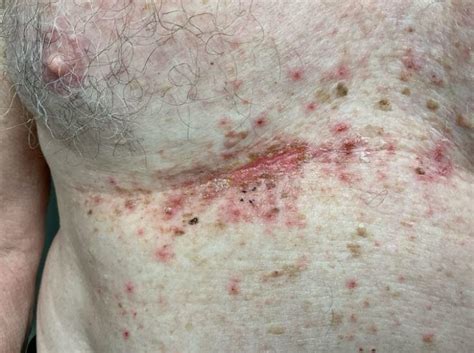 itchy rash  upper chest    red rash   years