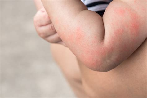 Sudamina nei bambini (FOTO) - Nostrofiglio.it