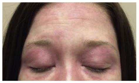 Heliotrope Rash Juvenile Dermatomyositis