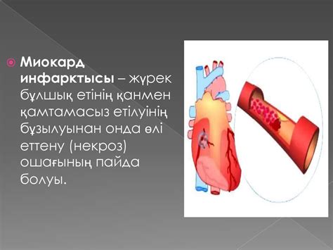 Миокард инфаркті ЭКГ белгілері - презентация онлайн