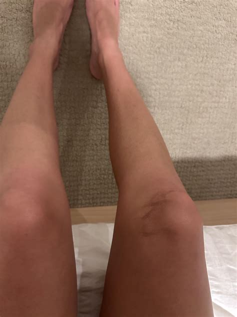 Weird bruising on knee : r/medical