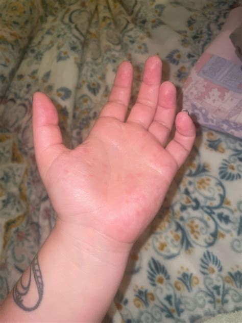 Weird red spots on palms : r/eczema
