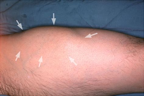 superficial hematoma