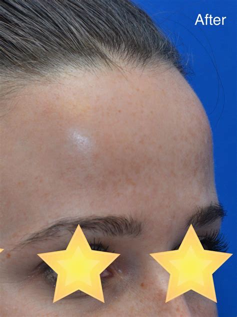 laser resurfacing for face 5