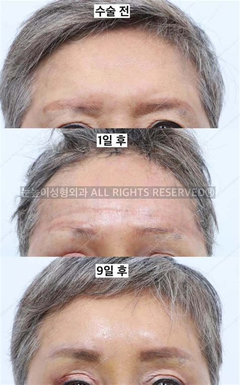 이마거상술 재수술 안 받으려면 » 성형외과전문의 박성혁