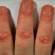Illustrates Gottron sign in juvenile dermatomyositis | Download ...