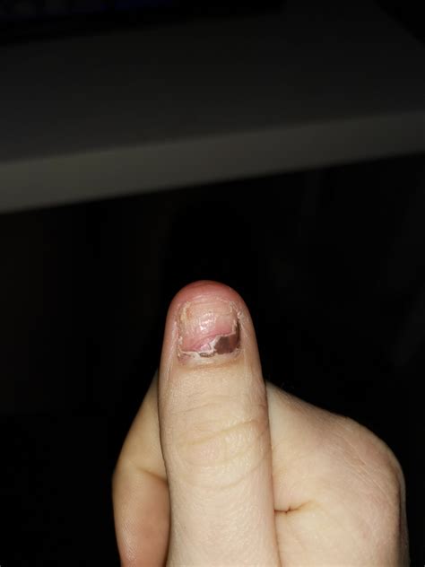Please can yall pray for my finger nail :'( ripped acrylic nail of and