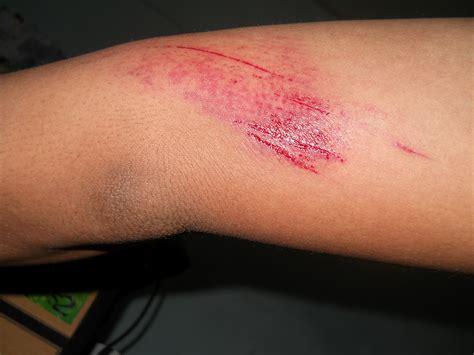 luka  lutut akibat jatuh  motor homecare