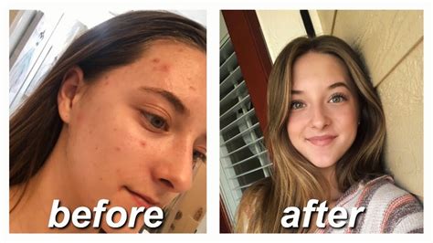 ACCUTANE FOR MILD ACNE // my story & monthly updates - YouTube