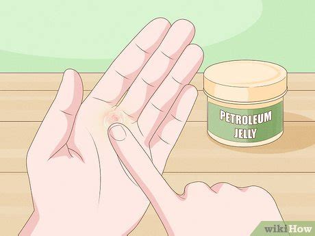 4 Ways to Heal Blisters - wikiHow