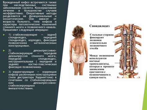 Кифосколиотические деформации - презентация онлайн