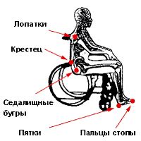 Стадии пролежней