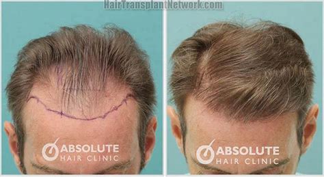 Dr. Kongiat Laorwong Hair transplant procedure before and after result ...
