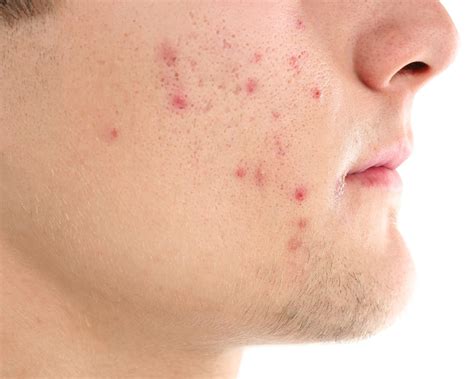 acne treatment canterbury skin  laser clinic
