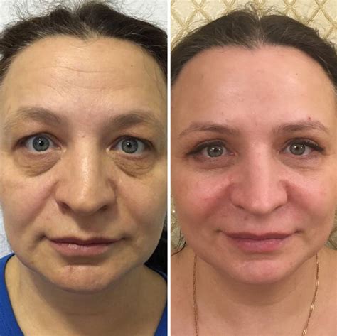 Плюсы блефаропластики