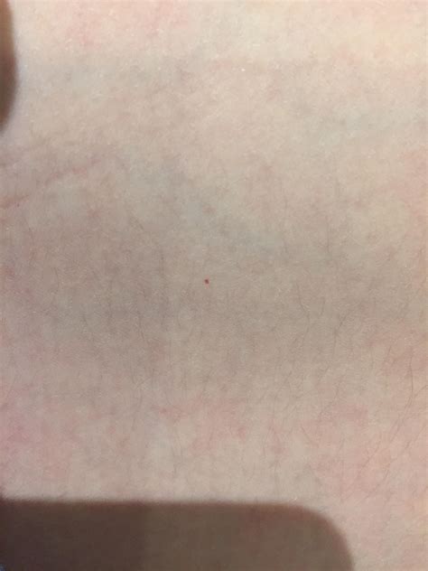 What are these small red dots on my skin? : r/medical