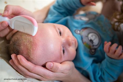 Neonatal Seborrheic Dermatitis