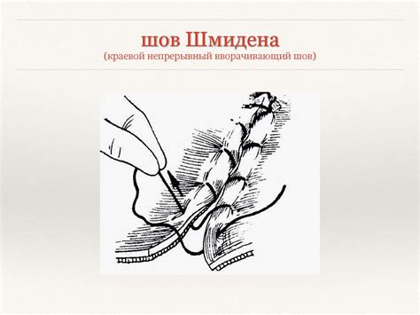 Кишечный шов - презентация онлайн