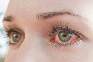 Olhos Ardendo E Doendo - Ardência nos olhos: 8 principais causas (e o que fazer) - Tua Saúde