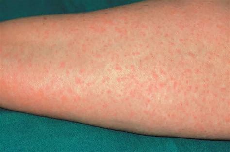Dr Medico Allergic Reaction Skin Rash Treatment - vrogue.co