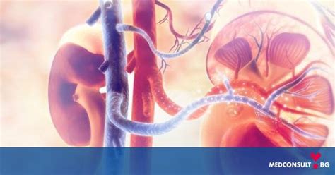 Страдате ли от камъни в бъбреците — Medconsult.bg