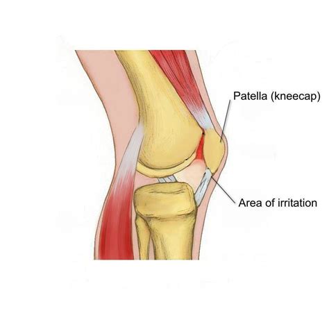 Runner’s Knee (PFJ Syndrome) | Physio Direct