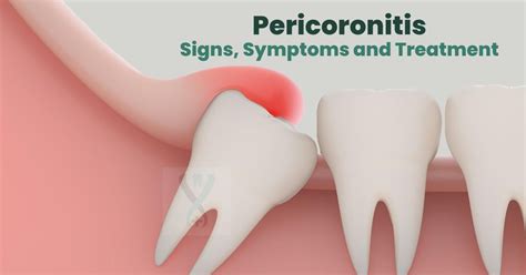 pericoronitis signs symptoms treatment wisdom tooth