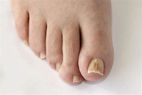 Come riconoscere la micosi alle unghie dei piedi – È Donna