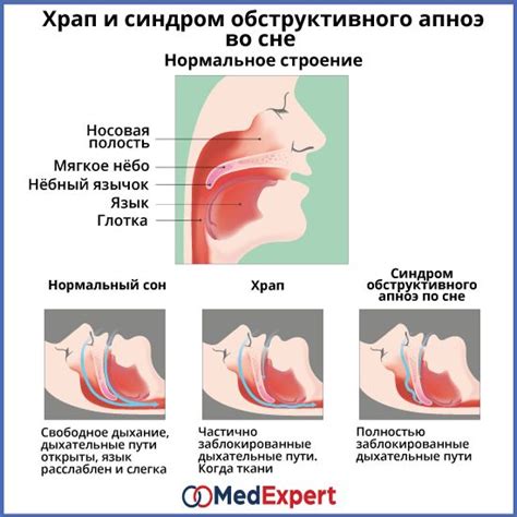 ХРАП И СИНДРОМ АПНОЭ | Храп, Полость носа, Терапия