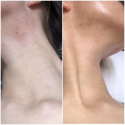 Stubborn closed comedones on underside of jaw! Damaged skin barrier or