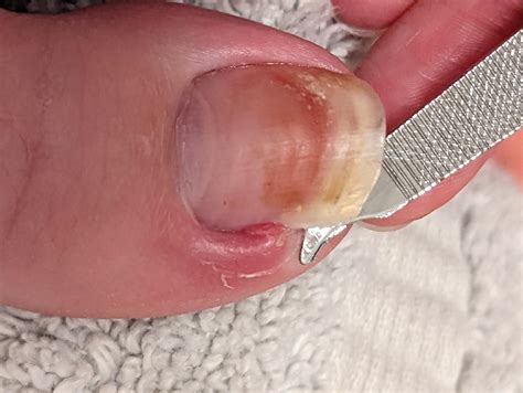 how to get rid of an ingrown toenail overnight 1